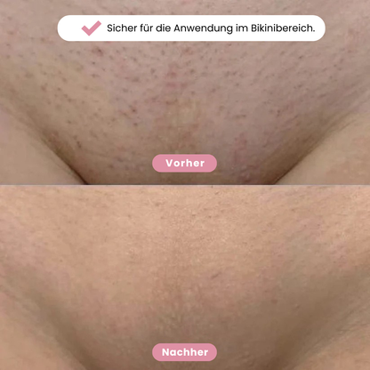 Eulacty™ Bikini-Trimmer